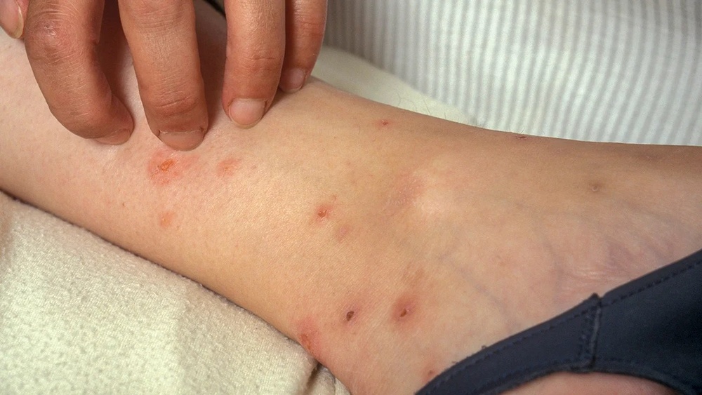 Can Fleas Bite Through Clothes