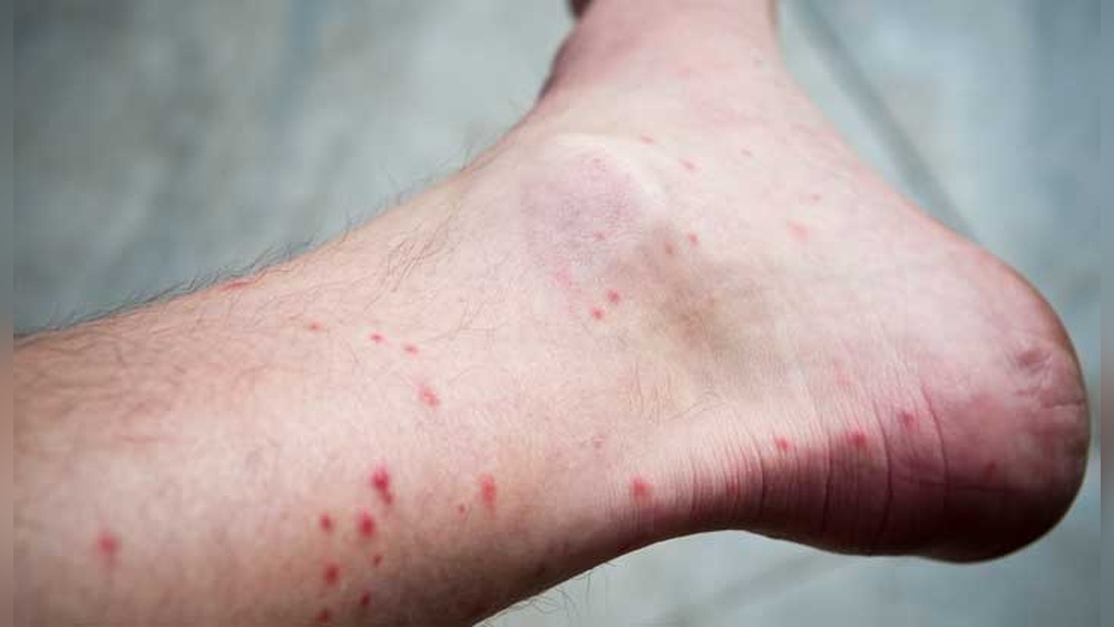 Can Humans Get Fleas from Cats