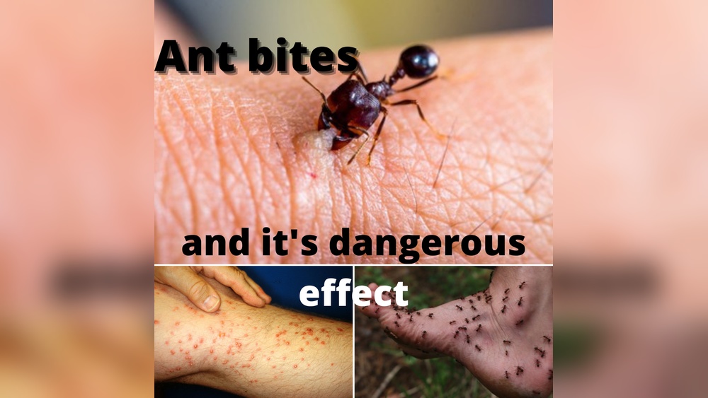How to Treat Fire Ant Bites