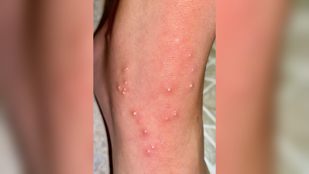 Should I Pop an Ant Bite