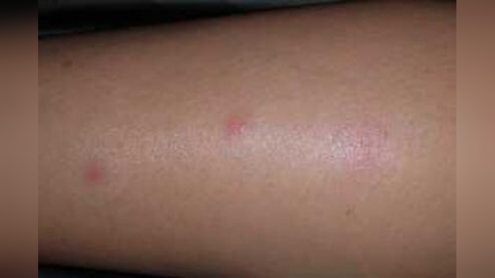 What Do Bed Bug Bites Look Like