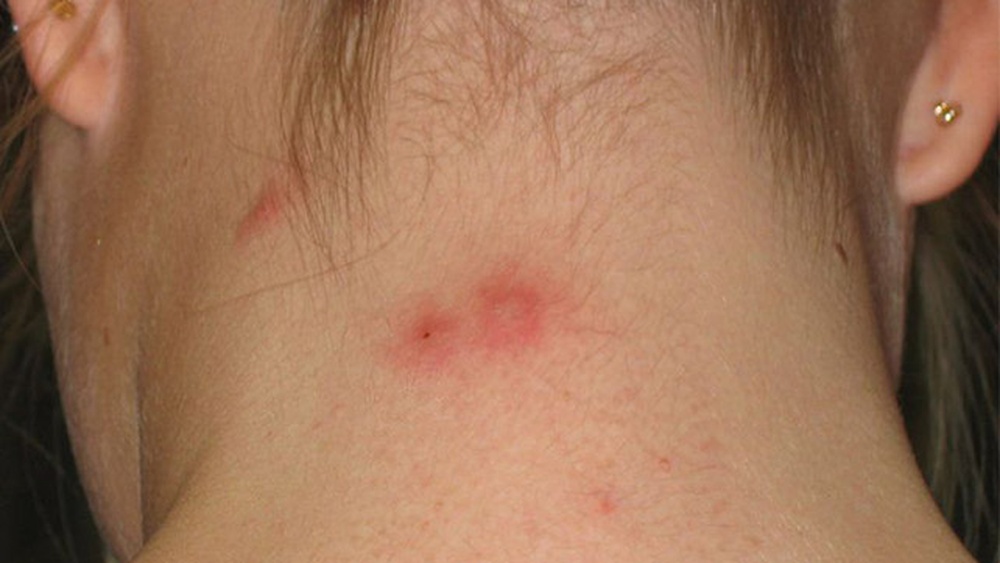 What Does an Earwig Bite Look Like