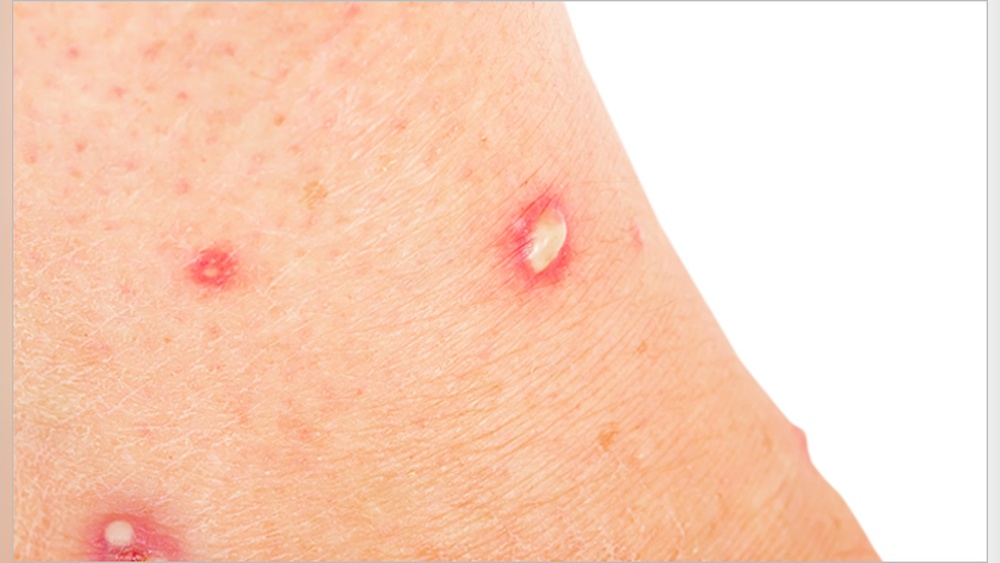 Why Do Ant Bites Itch