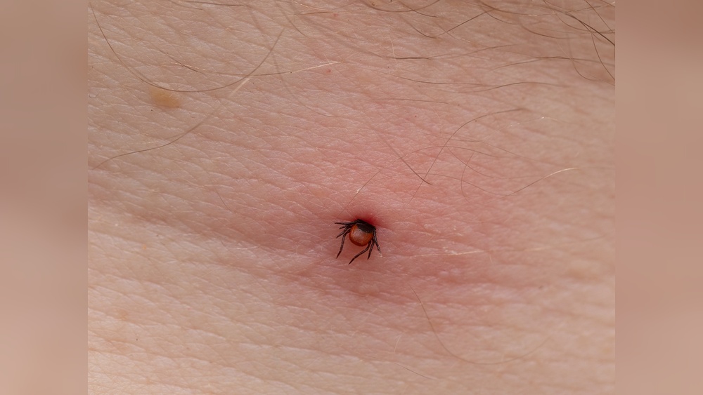Will Hydrogen Peroxide Kill Ticks